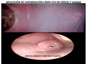 APLICACIÓN DE VAPORIZACIÓN LÁSER CO2 EN CÉRVIX Y VAGINA