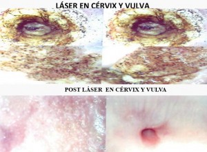 LÁSER EN CÉRVIX Y VULVA / POST LÁSER EN CÉRVIX Y VULVA