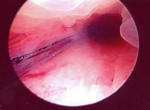 MICROCOLPOHISTEROSCOPIA: CANAL INTERNO DEL CÉRVIX NORMAL (ENDOCÉRVIX)