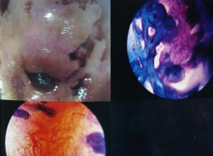 MICROCOLPOHISTEROSCOPIA: MICROCONDILOMA EN CANAL INTERNO DE CÉRVIX